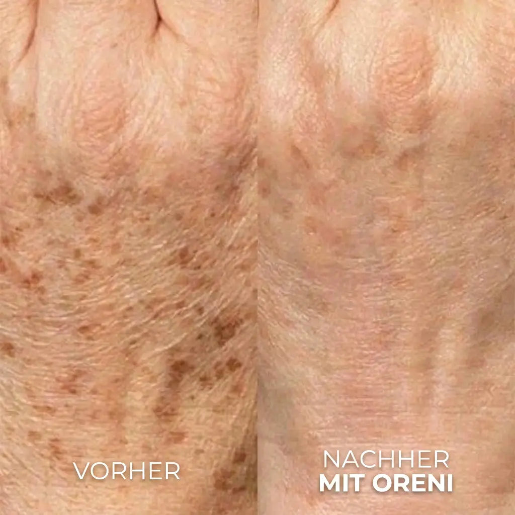 Oreni Altersflecken Komplett System