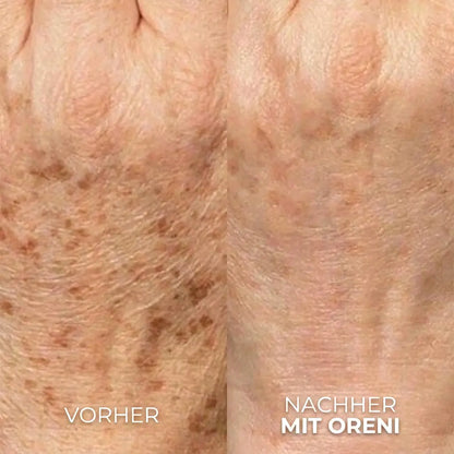 Oreni Altersflecken Komplett System