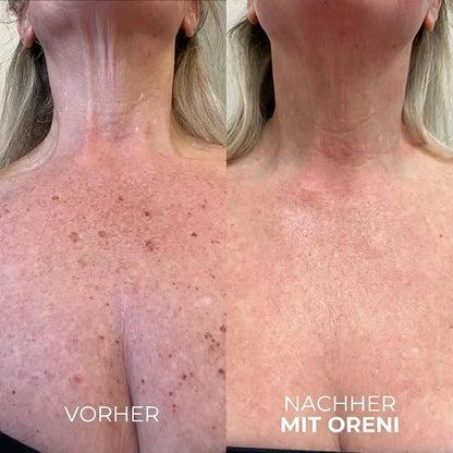 Oreni Altersflecken Komplett System